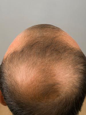 alopecia