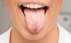 ​drymouth