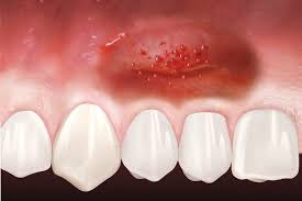 gum